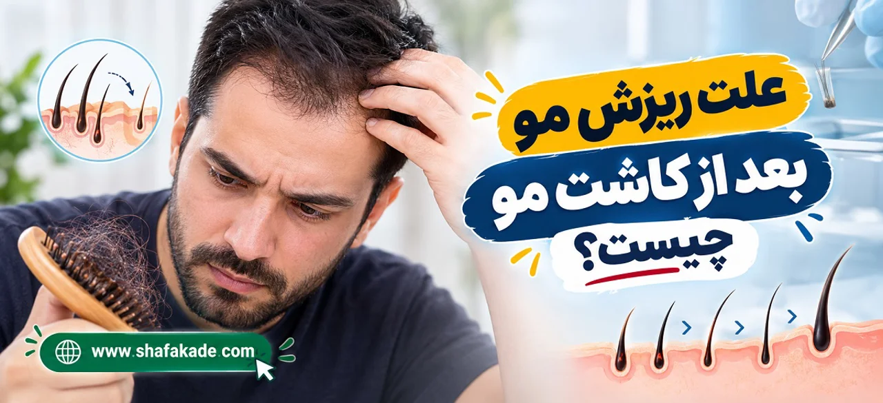 علت ریزش مو بعد از کاشت مو چیست؟